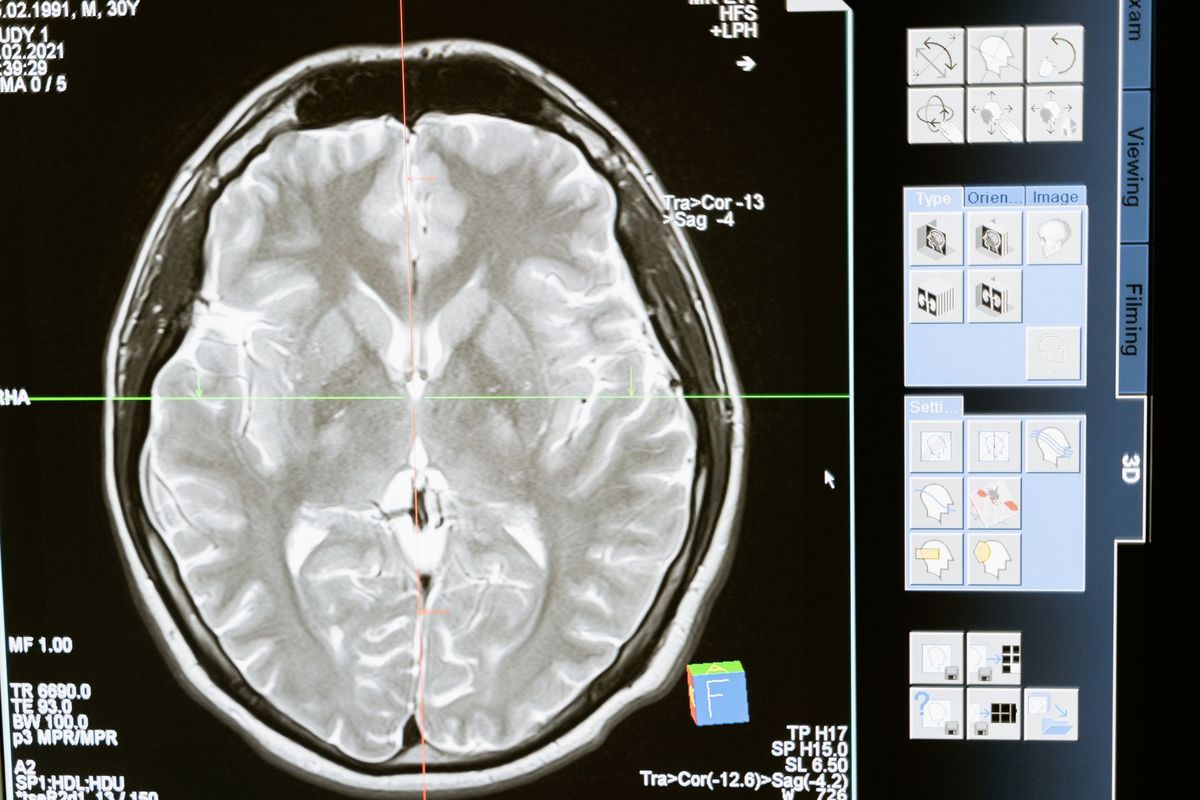 Week-Long Meditation Retreats Show Brain Changes